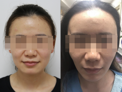 邱立东：毕业季整容热，学生求美需谨慎！